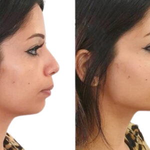 Dermal Filler Training